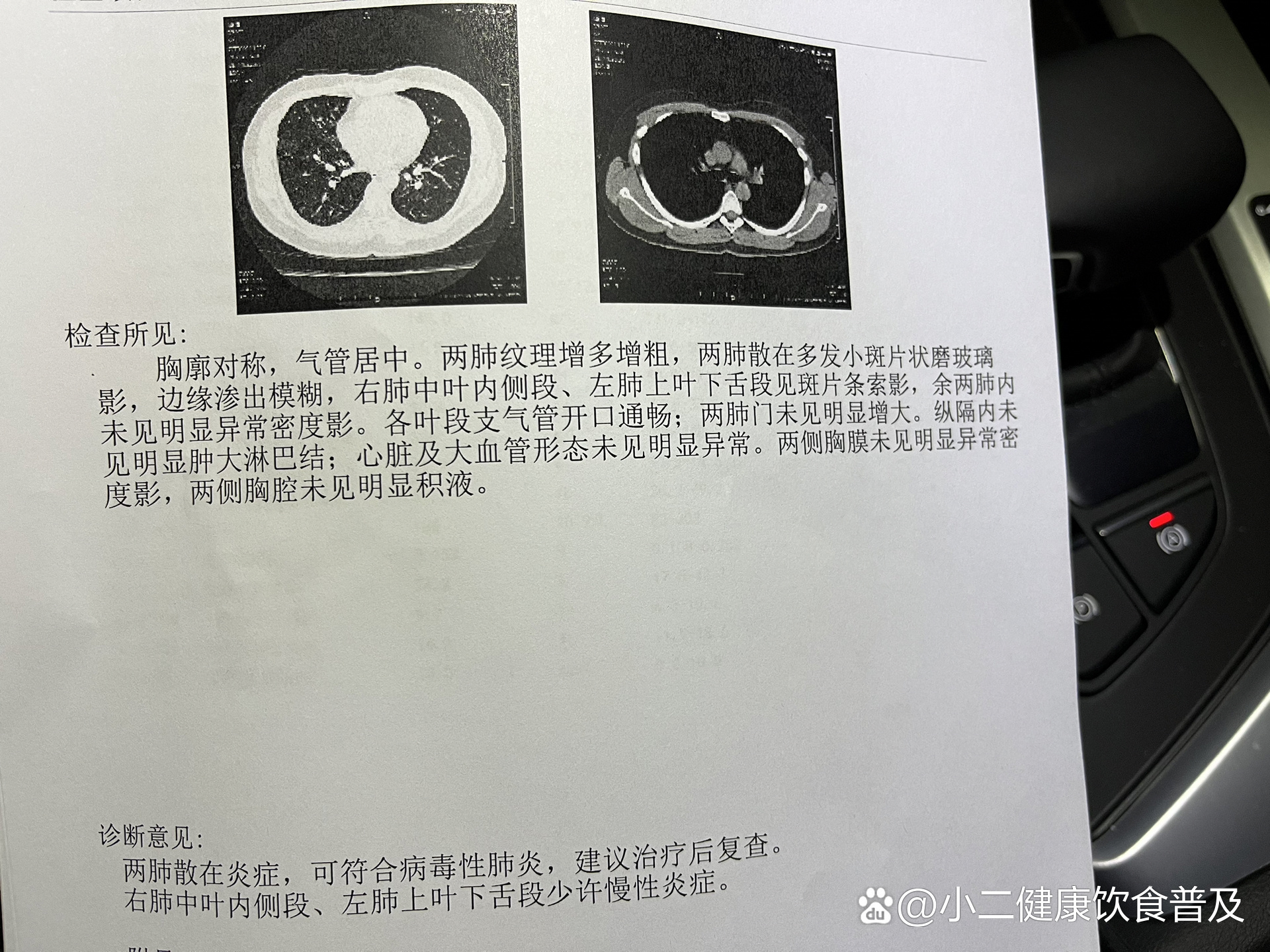 “成都确诊新型肺炎” 成都确诊冠状肺炎？