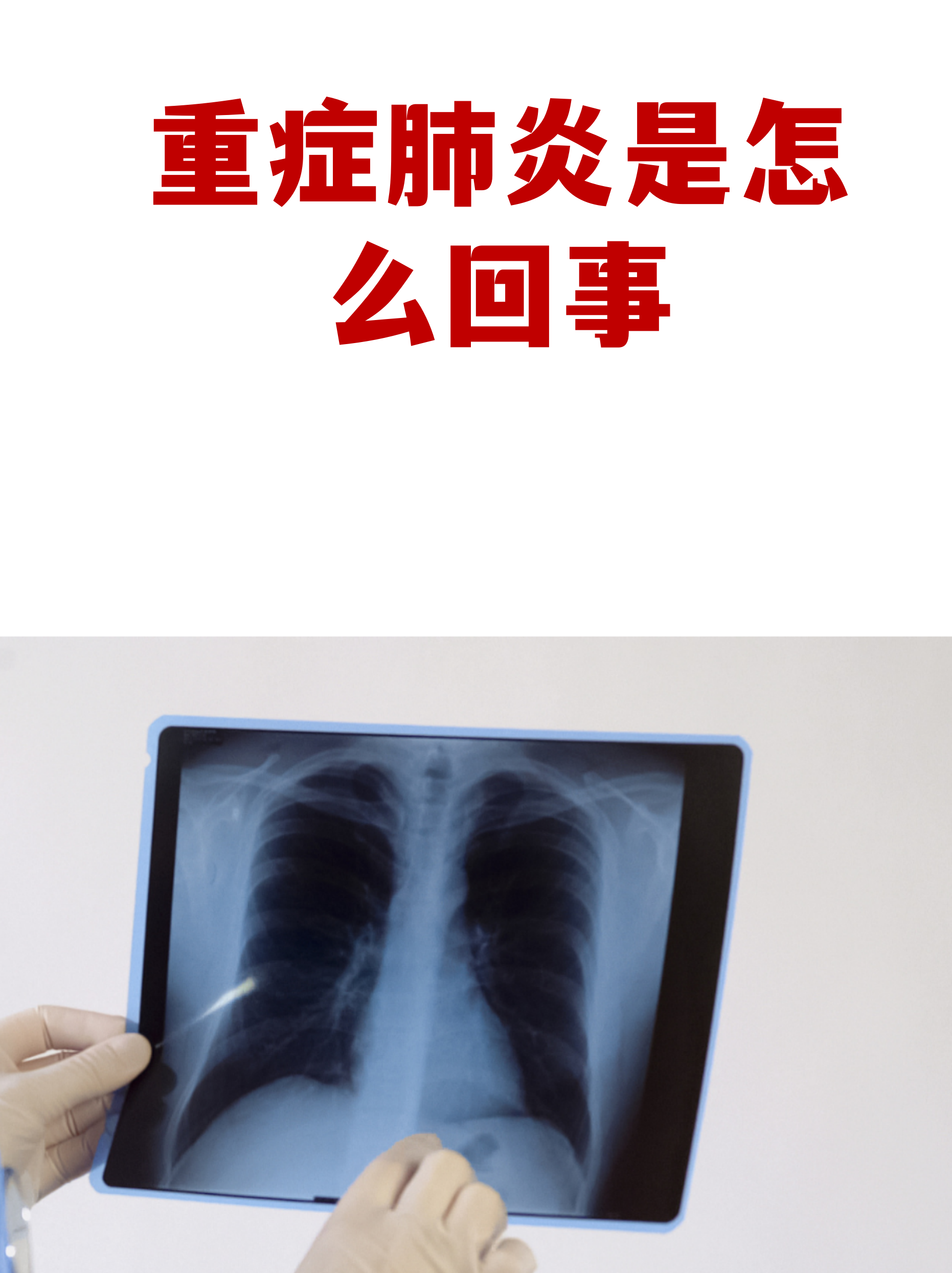 【北京现在多少例肺炎/北京近来有多少确诊肺炎】-第2张图片